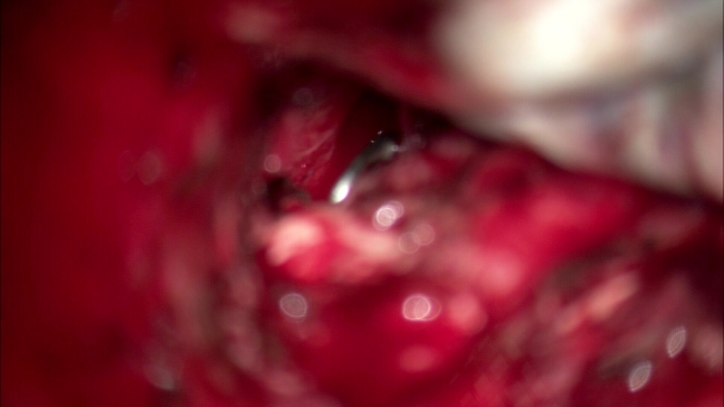 Patient_1_2018-09-19_15-46-20_V_11