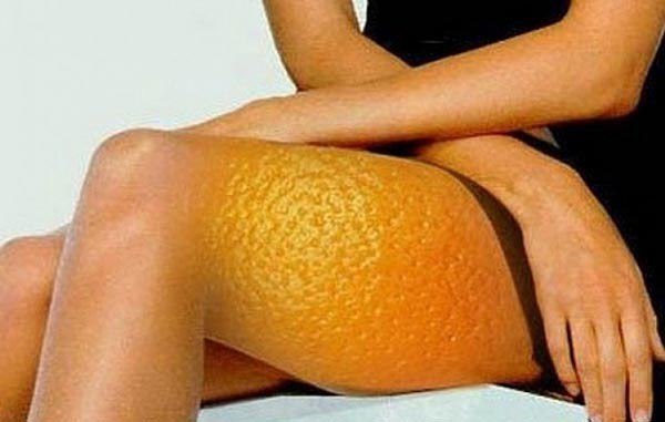 Целлюлит и проблемы изображения Целлюлит и проблемы изоражения