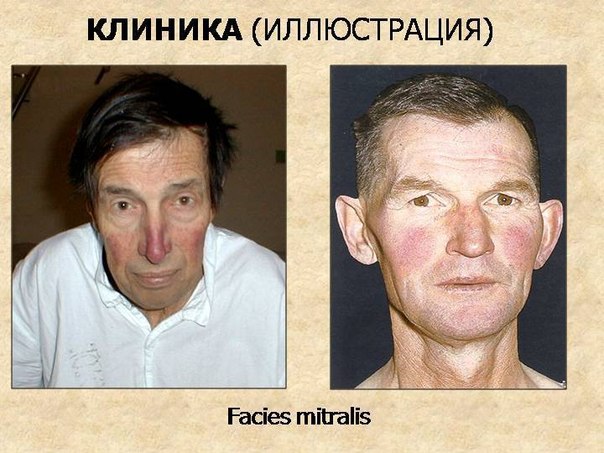 Характерные изменения лица больного при заболеваниях сердца 