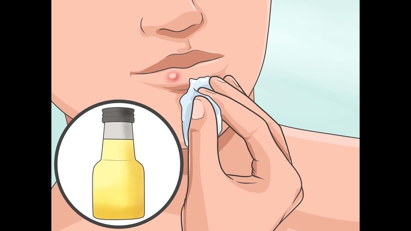 How to cure herpes naturally