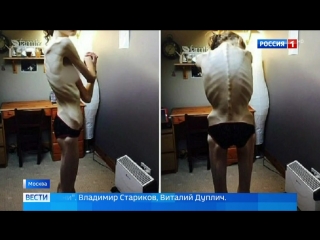 Анорексия: зона риска начинается с 12 лет