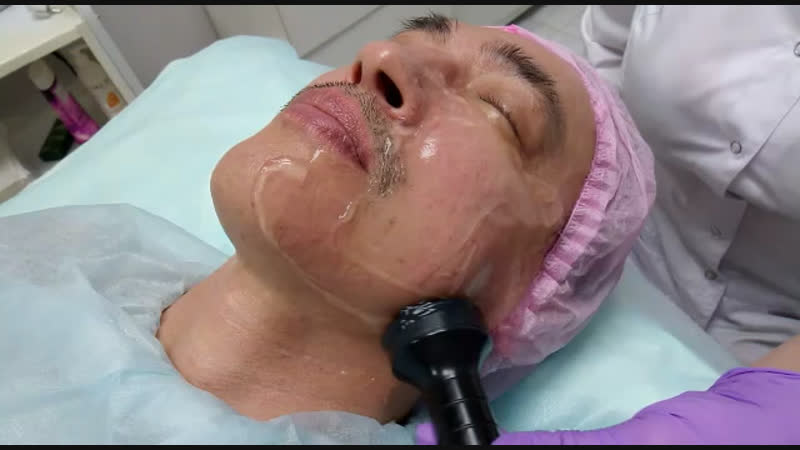 Радиоволновой лифтинг лица