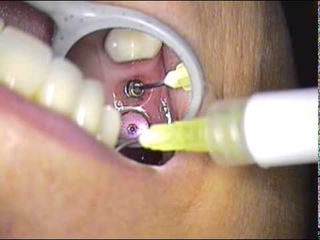 DR. GERARD CUOMO Implant Dentistry June's Case 3 Boca Raton Florida