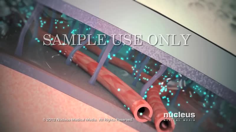Viral Meningitis