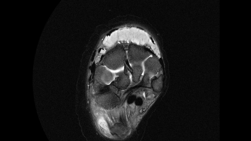 MRI scan of elephant right hind foot