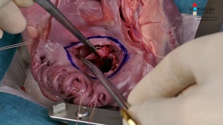 Implantation of Perceval Valve In Mitral Position – A New Technique