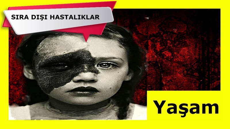 SIRADIŞI HASTALIKLAR VE BELİRTİLERİ