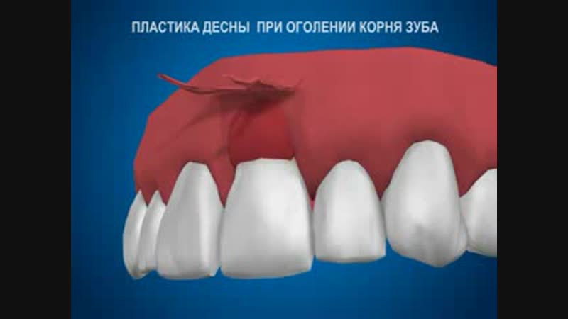 Пластика десны