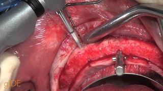 CV-52 All-on-4 Upper Jaw Implant Surgery - Surgical steps (Part 2) PREVIEW