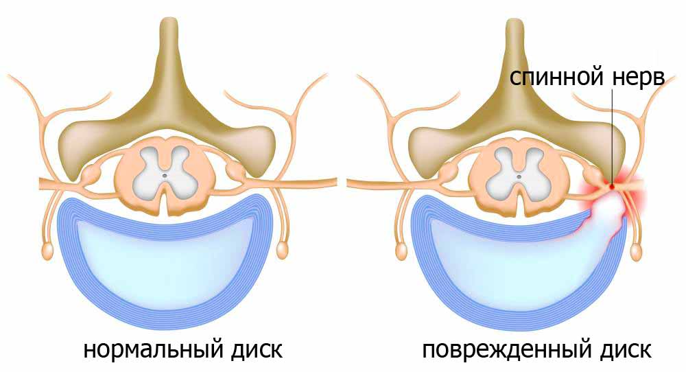боль в спине от грыжи межпозвоночного диска