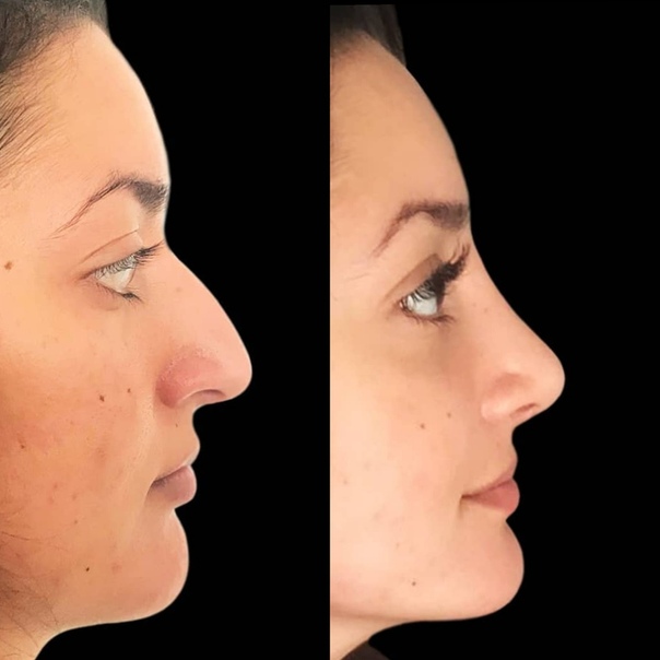 Ринопластика нижний новгород