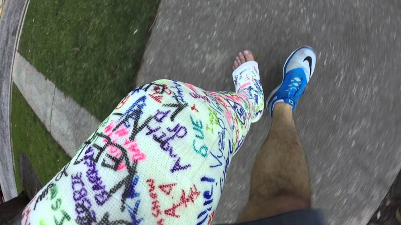 Leg cast crutch cam