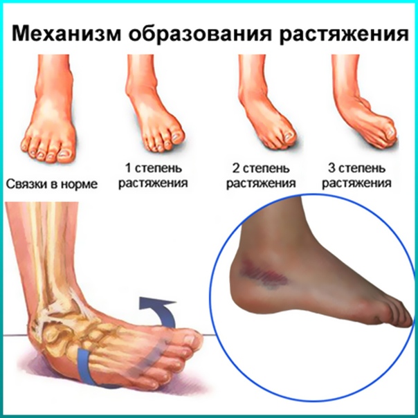Растяжения и разрывы связок 