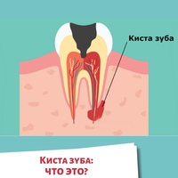 &#55357&#56462Киста зуба: что это? Киста зуба – патологическое образование, заполненное серозным или гнойным с…
