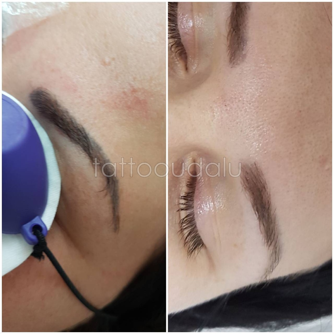 удаление лазером мурманск